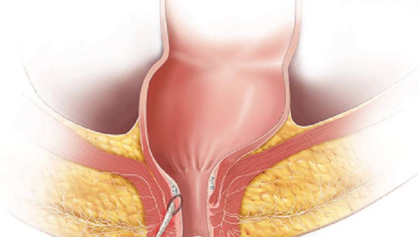 What Happens if Fistula is Not Treated on Time